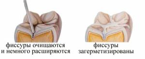 запечатывание фиссур