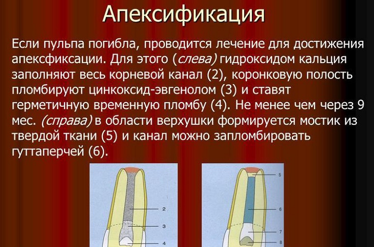 Как проводится апексификация