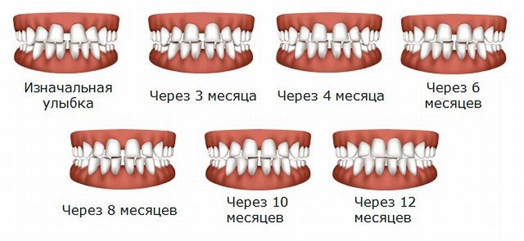 процесс исправления прикуса элайнерами