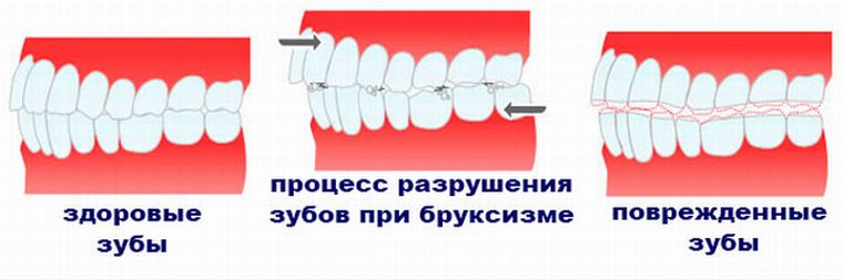 разрушение зубов при бруксизме
