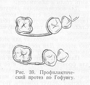 профилактический протез