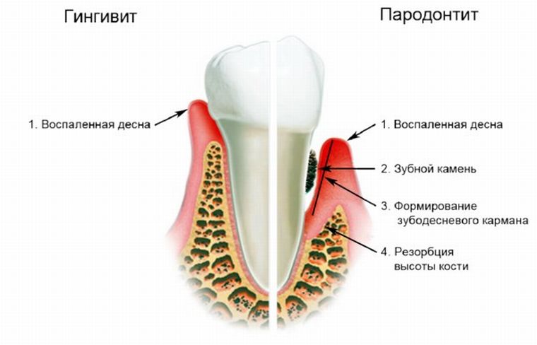 Гингивит и пародонтит