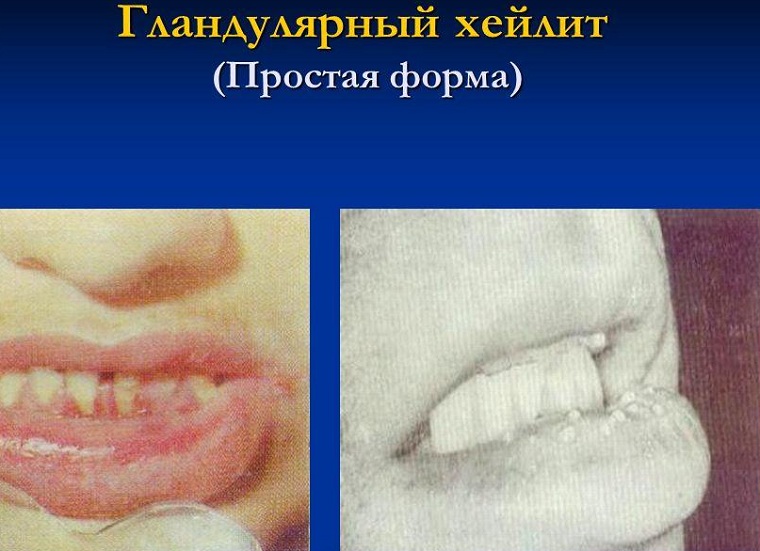 Симптомы хейлита