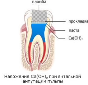витальная ампутация пульпы