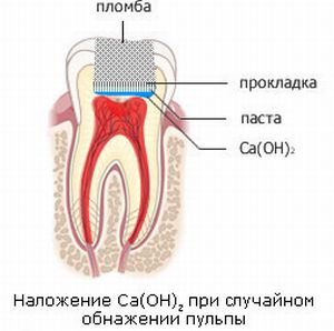 Установка пломбы на зуб