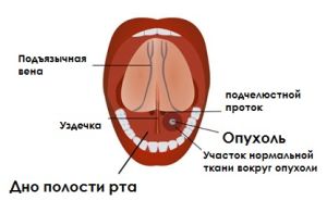 рак дна рта