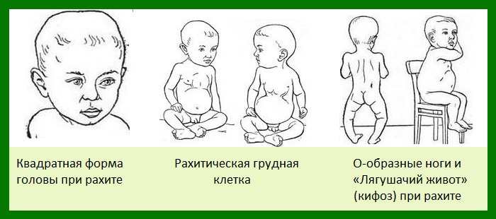 рахит