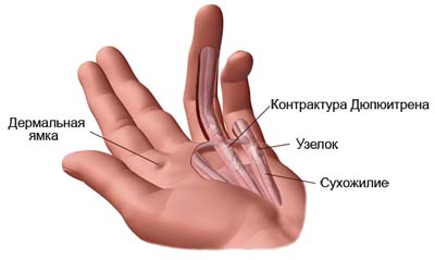 Контрактура Дюпюитрена