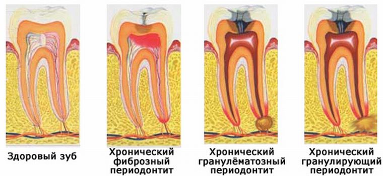формы периодонтита