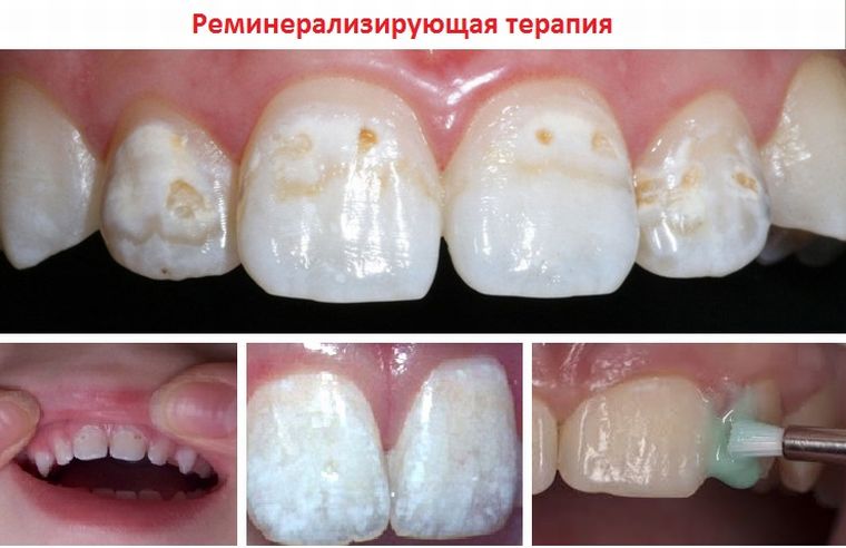 реминерализация зубной эмали