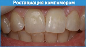Реставрация компомером