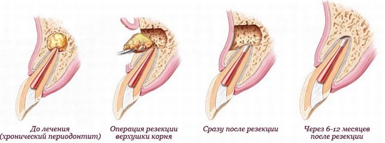 результат апексэктомии