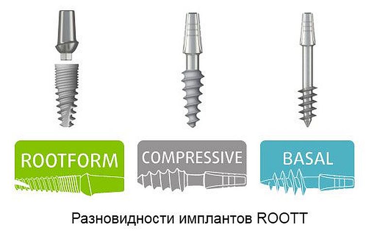 виды имплантов Roott