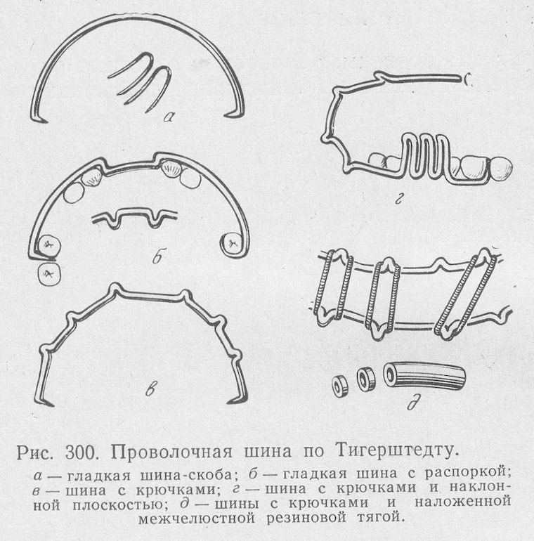 шины Тигерштедта