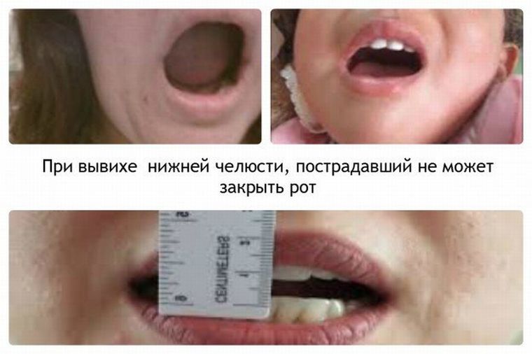 Симптомы вывиха челюсти