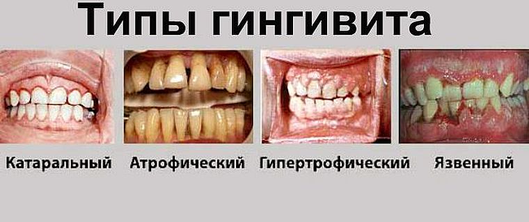 формы гингивита