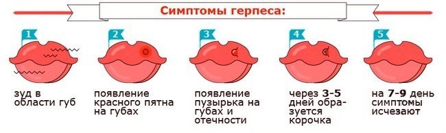 Симптомы герпеса