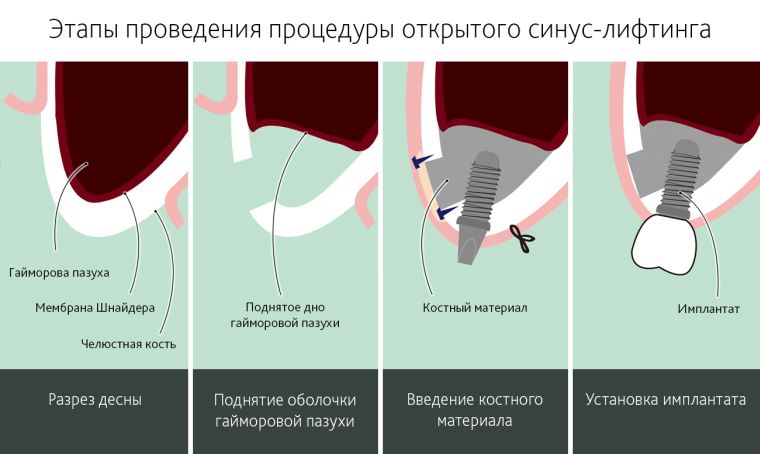 синус лифтинг