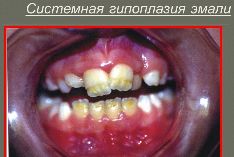 гипоплазия системная