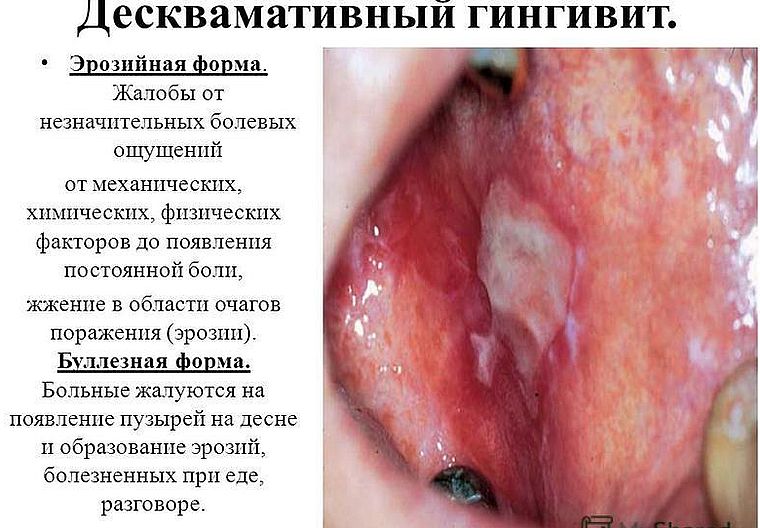 десквамативный гингивит