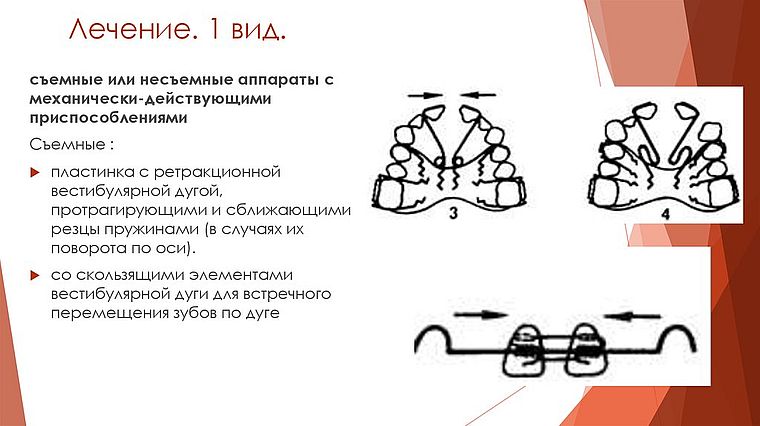 лечение диастемы пластинами