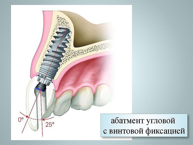 абатмент для винтовой фиксации