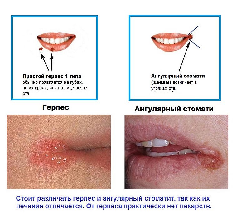 отличие от герпеса