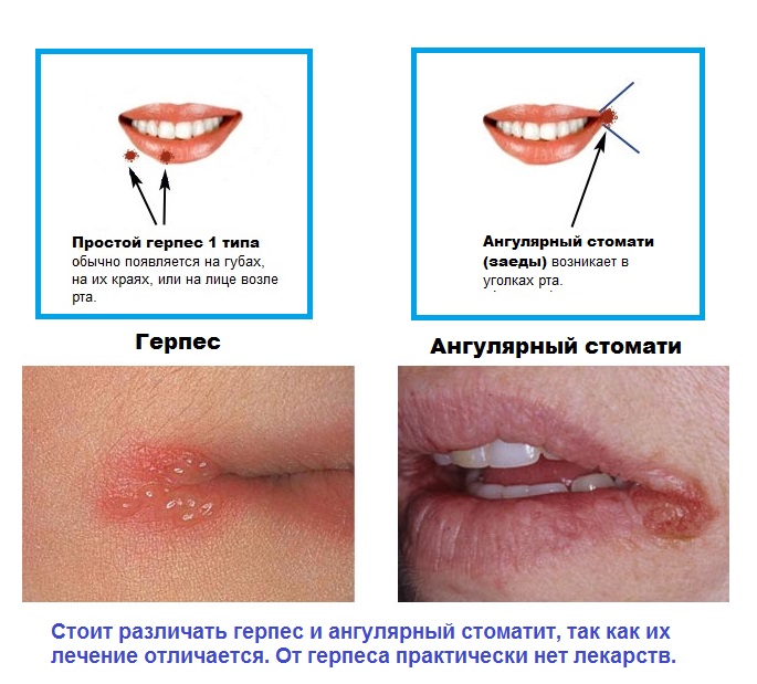 герпетический и ангулярный стоматит