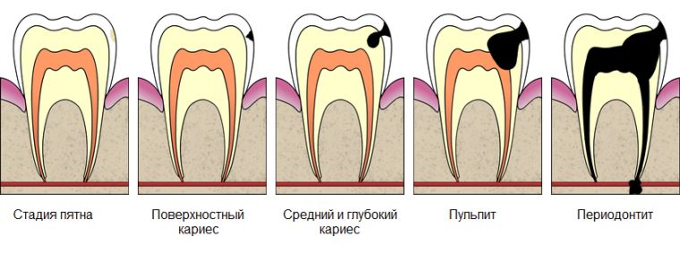 Стадии кариеса