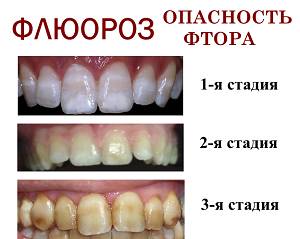 стадии развития флюороза