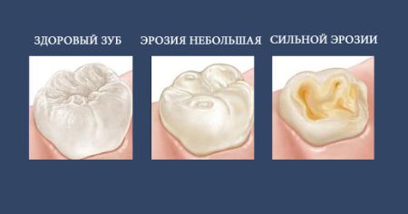 стадии разрушения зубов