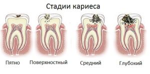 стадии кариеса