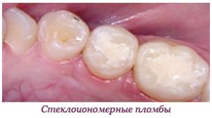 стеклоиономерные пломбы