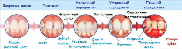 Стадии пародонтита