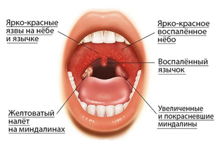 Первые проявления гингивостоматита