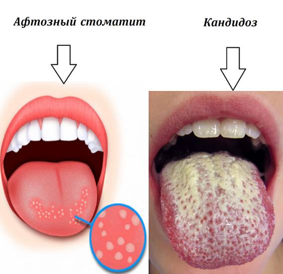 кандидоз языка