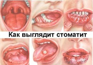 стоматит