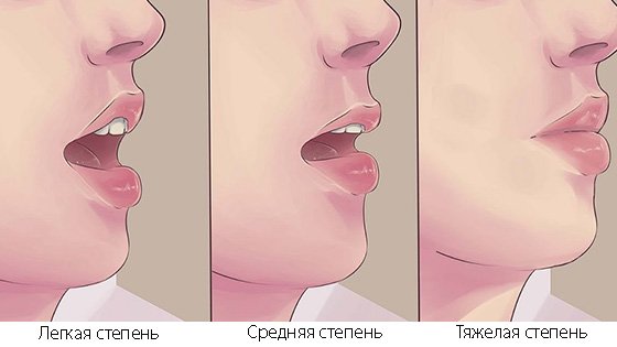 Степени тризма