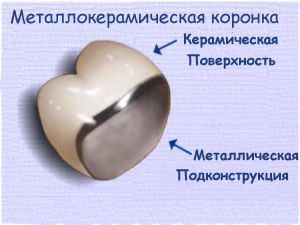 металлокерамическая коронка