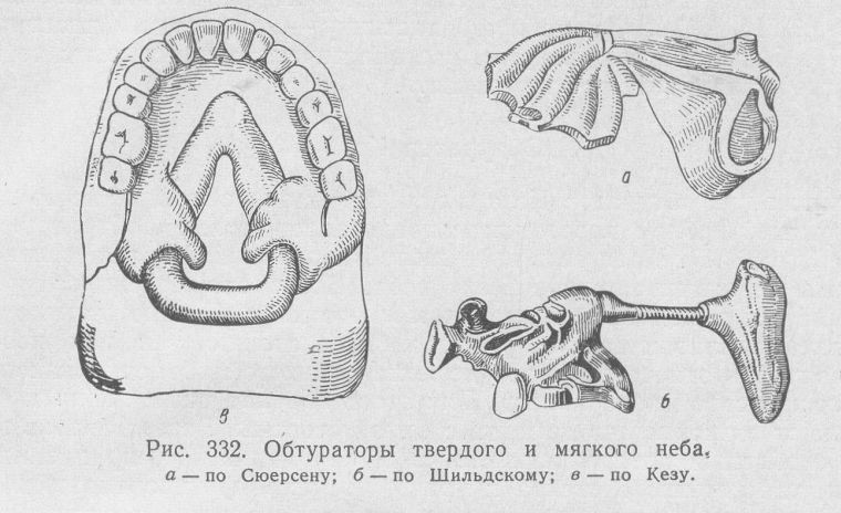 обтуратор Кеза