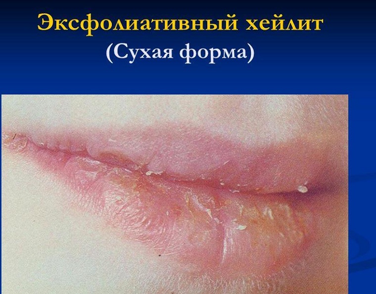 Сухая форма хейлита