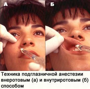 Техника подглазничной анестезии