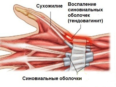 Тендовагинит