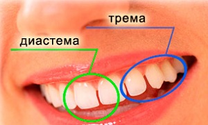 трема и диастема