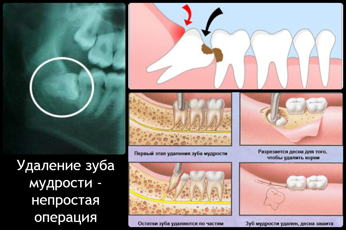 удаление зуба мудрости