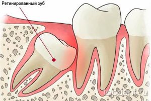 Ретинированный зуб