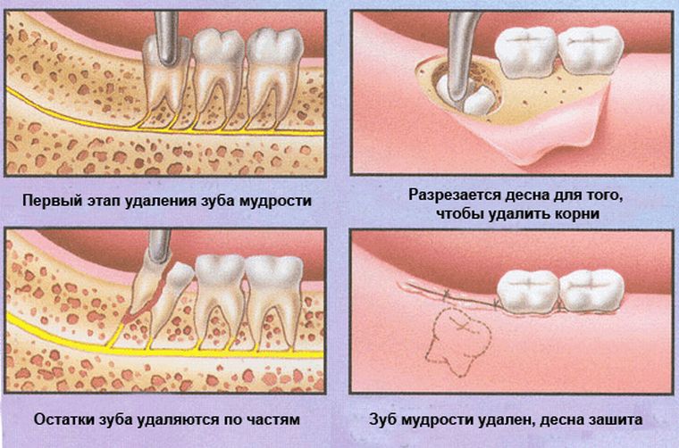 Удаление зуба мудрости