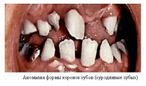 Уродливые зубы