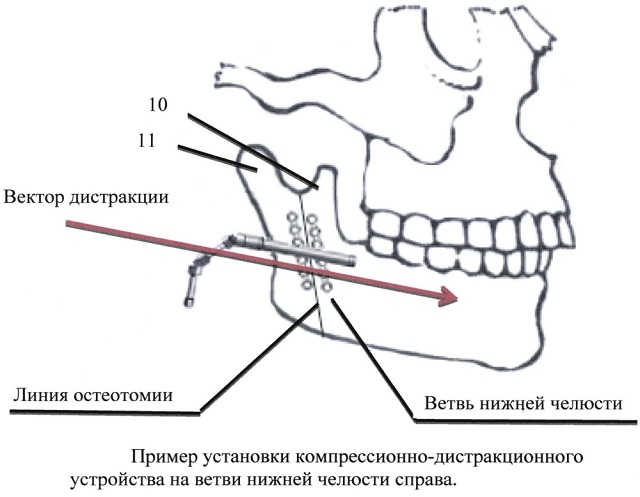 дистракционный остеогенез
