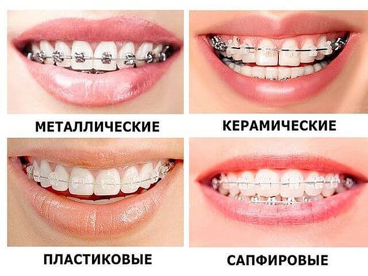 брекеты: виды